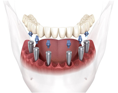 GD Dentistry | Dental Lab, All-on-4 reg  and Oral Exams